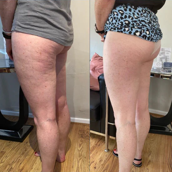 Cliente segurando o massageador elétrico corporal LinfMax