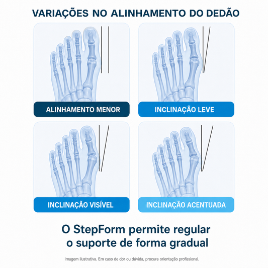 Ilustração de variações no alinhamento do dedão para uso informativo
